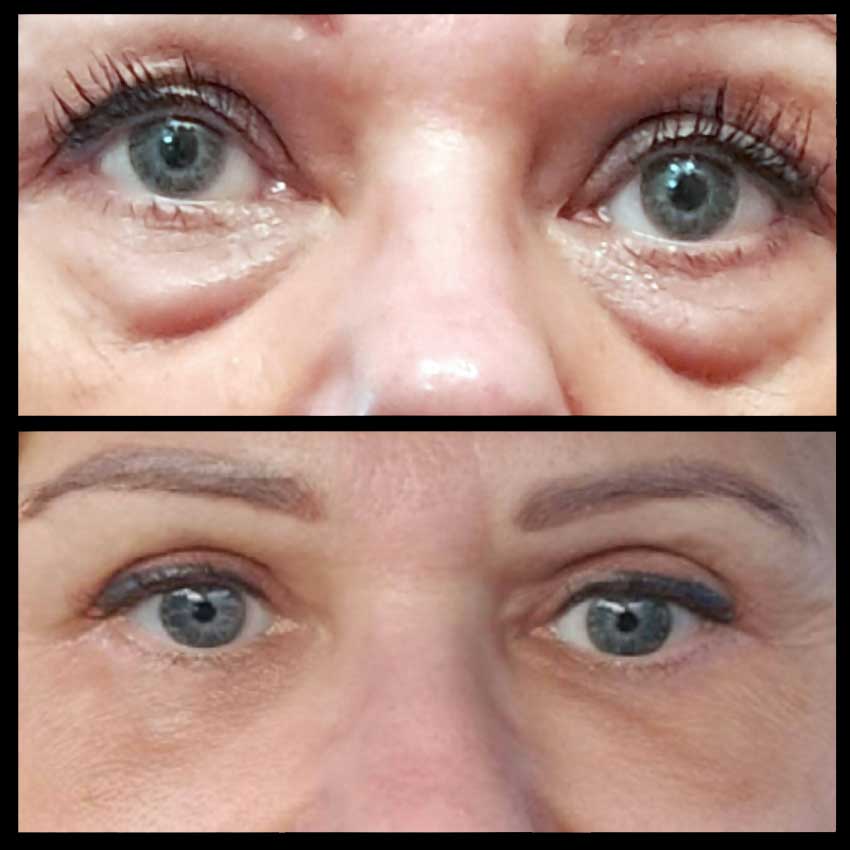 dr Piotr Bargiel Plastyka powiek dolnych