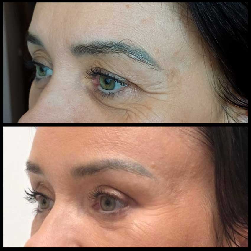 dr Piotr Bargiel Plastyka powiek dolnych