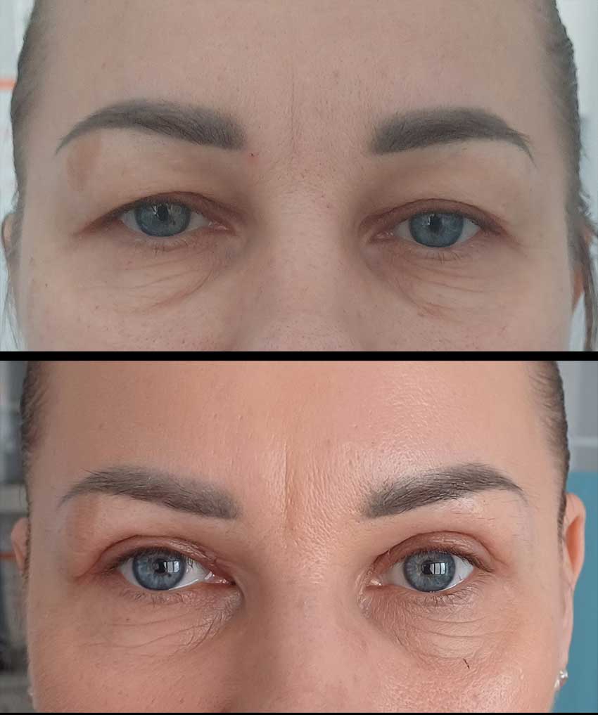 dr Piotr Bargiel Plastyka powiek górnych