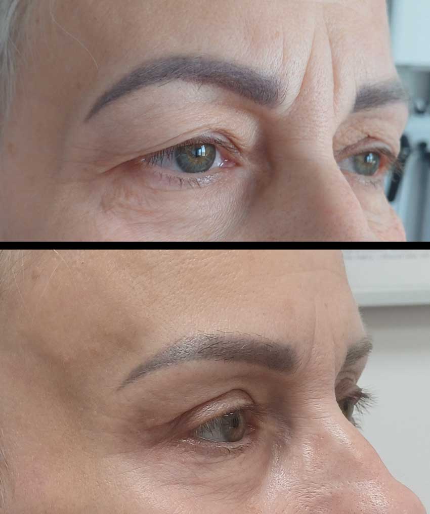 dr Piotr Bargiel Plastyka powiek górnych