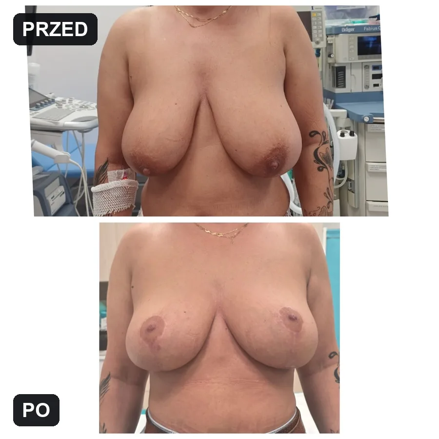 Lifting piersi - efekt przed i po (przypadek 2)