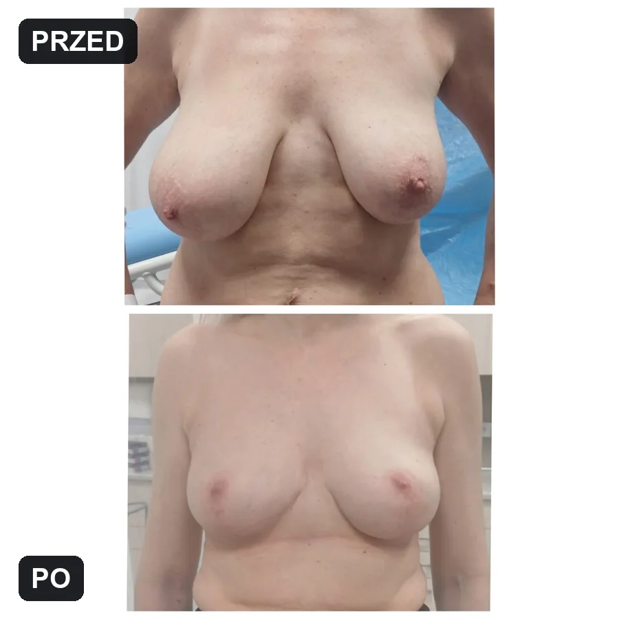 Lifting piersi - efekt przed i po (przypadek 3)