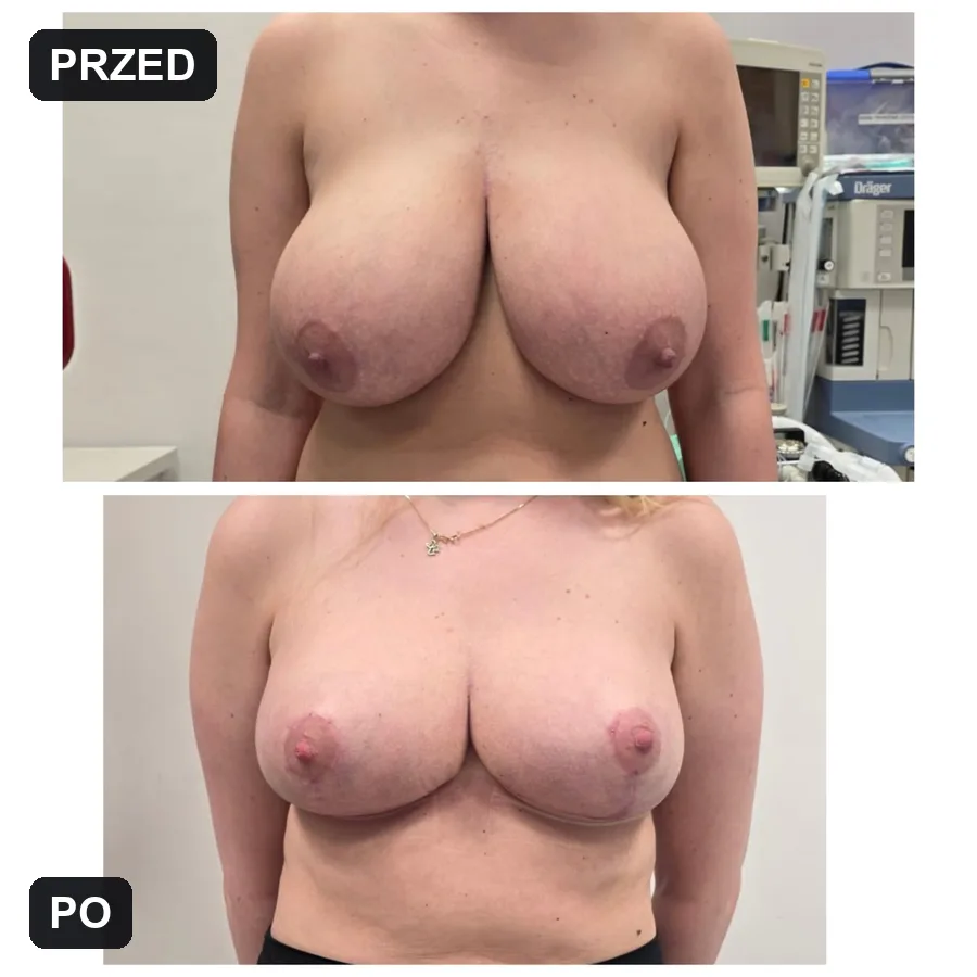 Lifting piersi - efekt przed i po (przypadek 5)