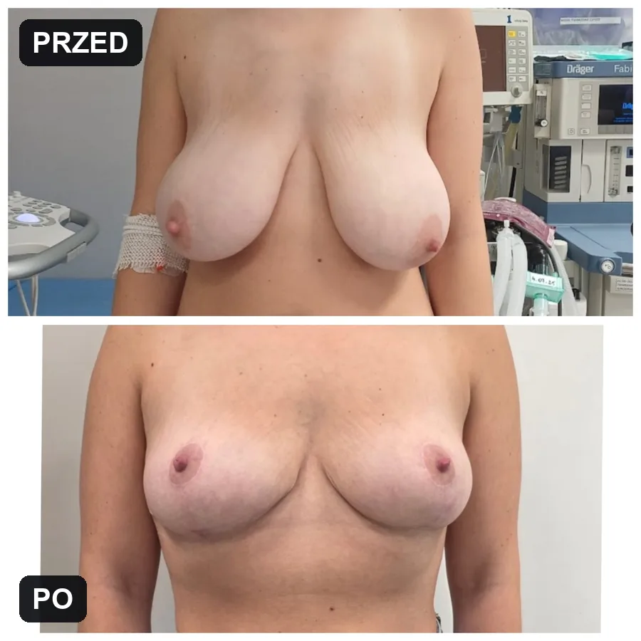 Lifting piersi - efekt przed i po (przypadek 6)