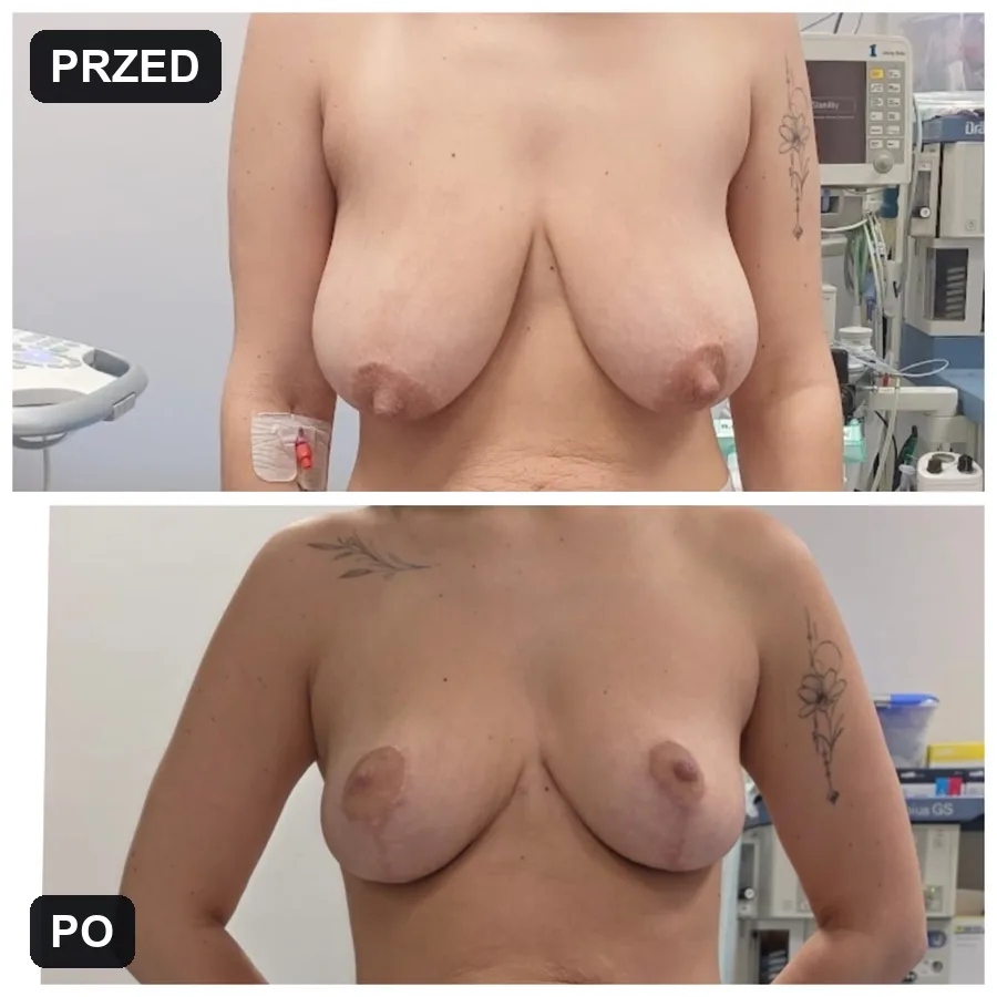 Lifting piersi - efekt przed i po (przypadek 7)