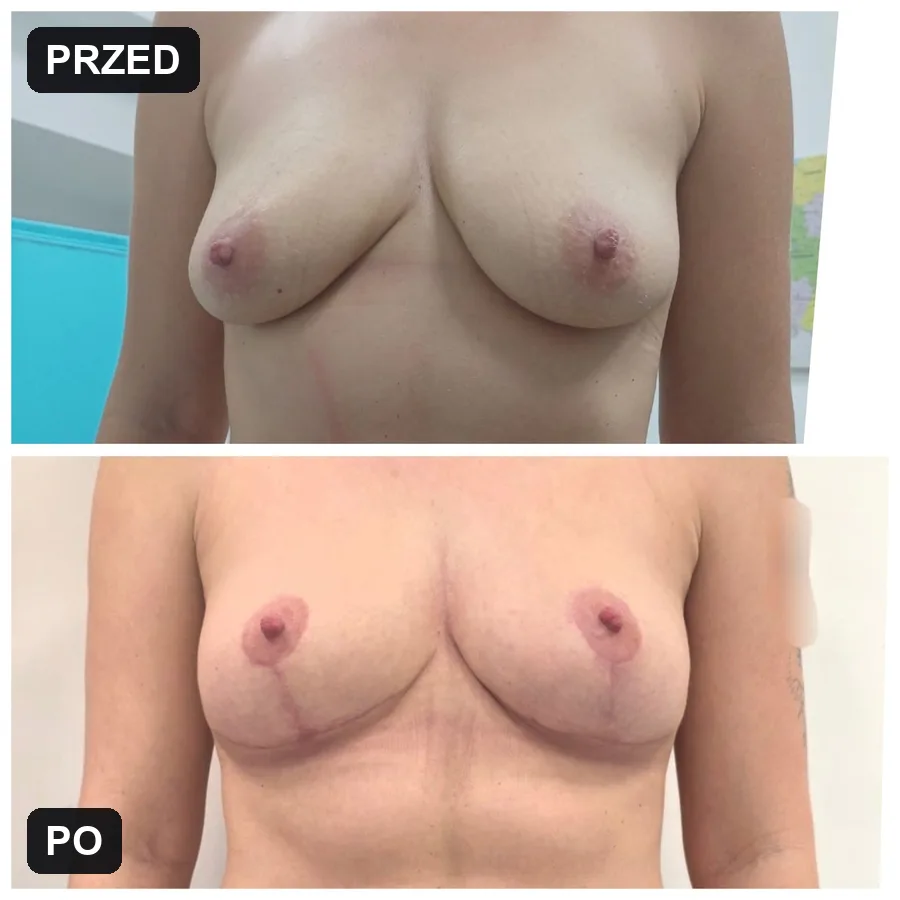 Lifting piersi - efekt przed i po (przypadek 8)