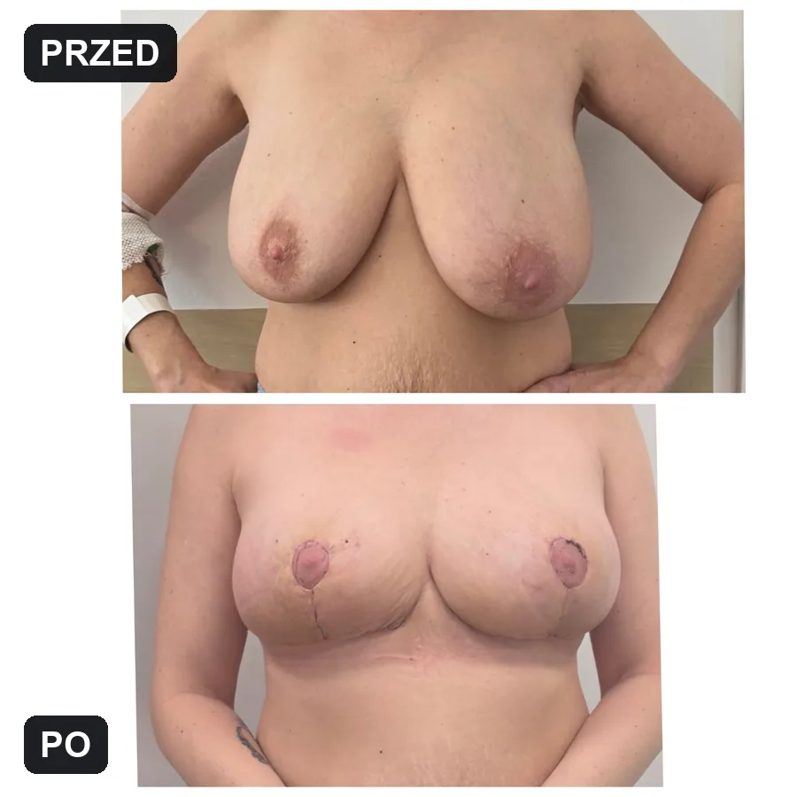 Lifting piersi - efekt przed i po (przypadek 9)